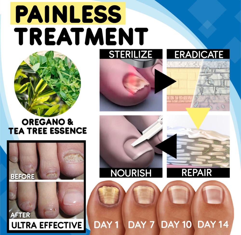 Nail Fungus Home Treatment Set