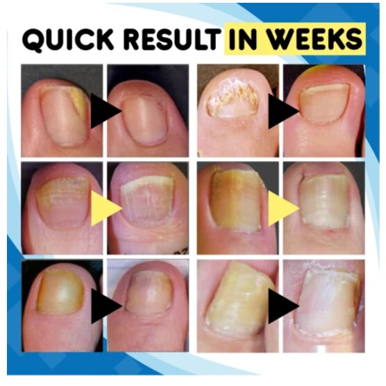 Nail Fungus Home Treatment Set